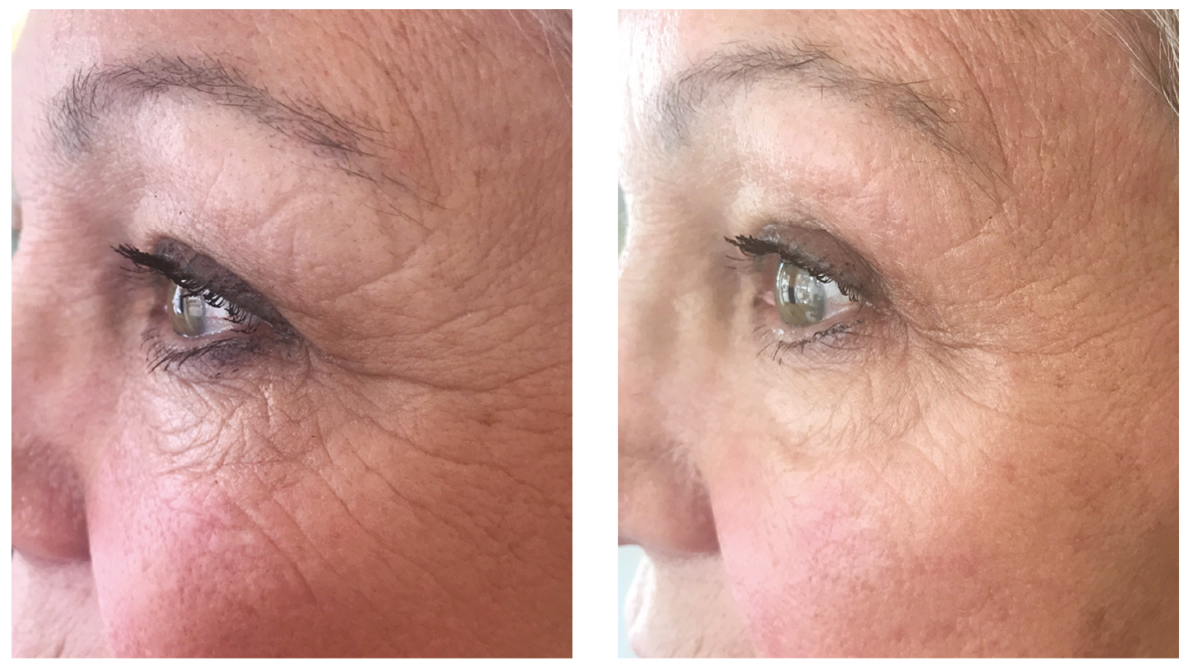 Heaven Lipolis7 before and after